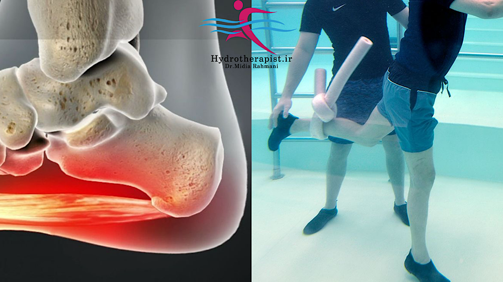 خار پاشنه و درمان آن با آبدرمانی